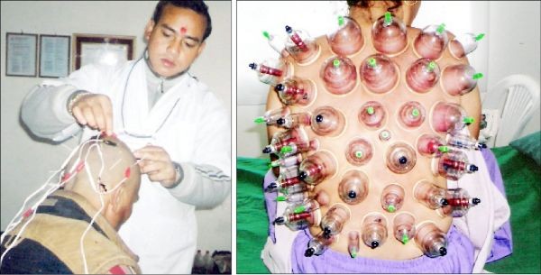 (left) Dr Tanka Bahadur Thapa administers accupuncture treatment to a patient suffering from mental illness. (right) A woman undergoes 'Cupping' therapy to rid herself of back-related complications.